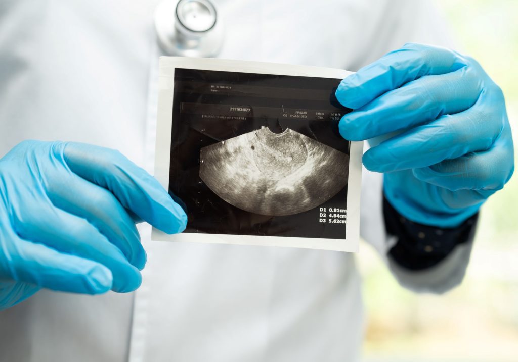 Lekarz w rękawiczkach lekarskich trzyma zdjęcie z USG - ilustracja dotycząca USG uroginekologicznego w Centrum Medycznym neoMedica w Poznaniu.
